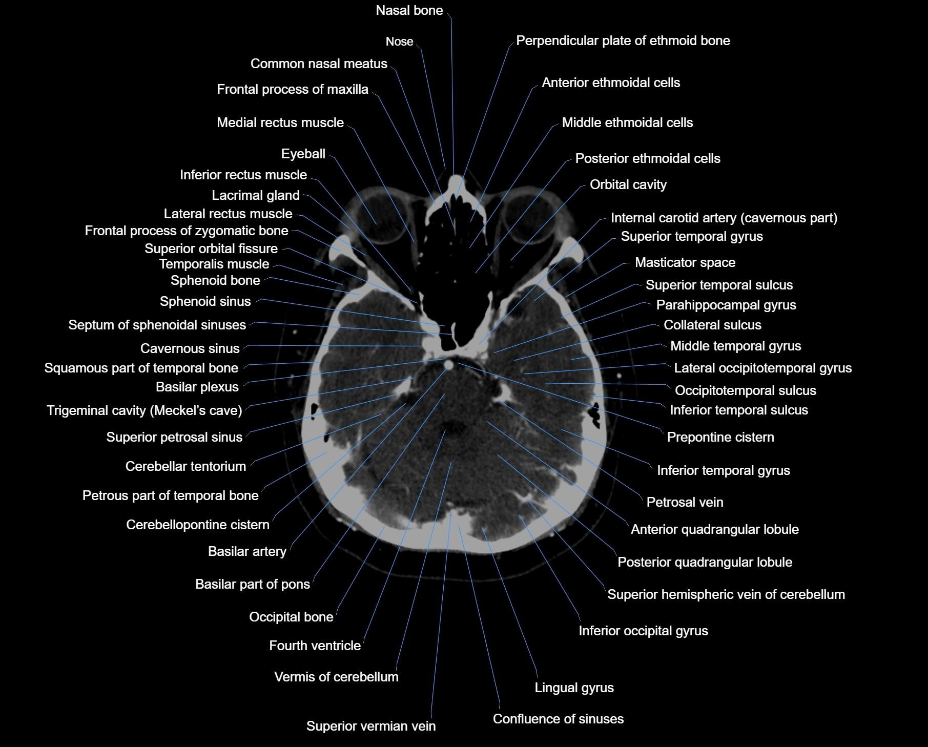CT scan brain axial labelled cross sectional anatomy image-img-000021.webp